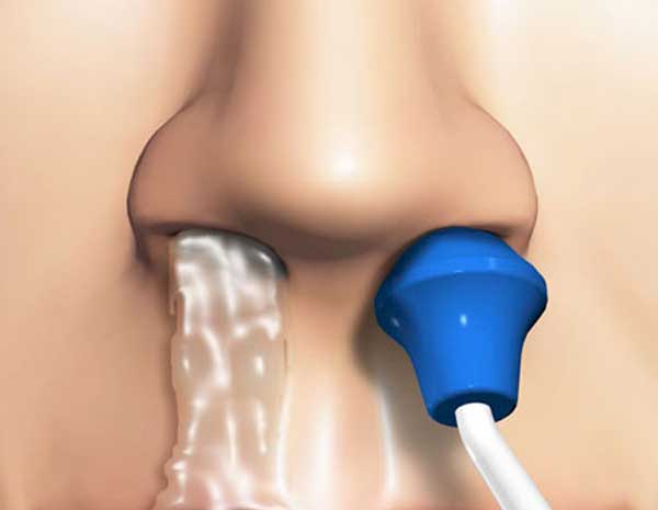 Irrigación nasal